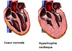 lhypertrophie-cardiaque